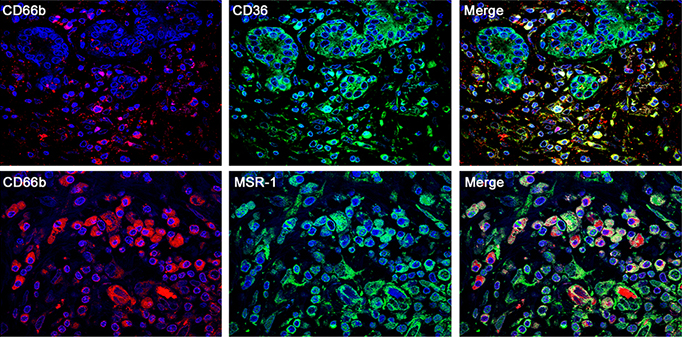 metabolic markers in triple negative breast cancer